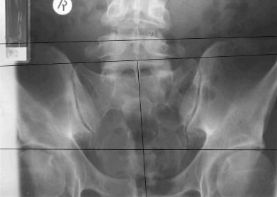 pelvis x-ray